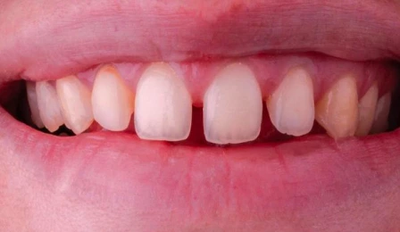 Dentition avant traitement