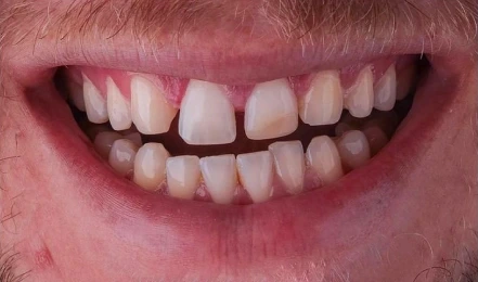 Dentition avant traitement